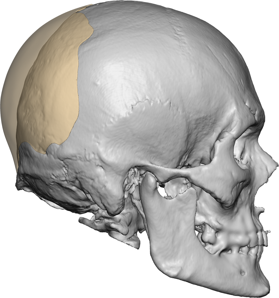 skull, occipital implant