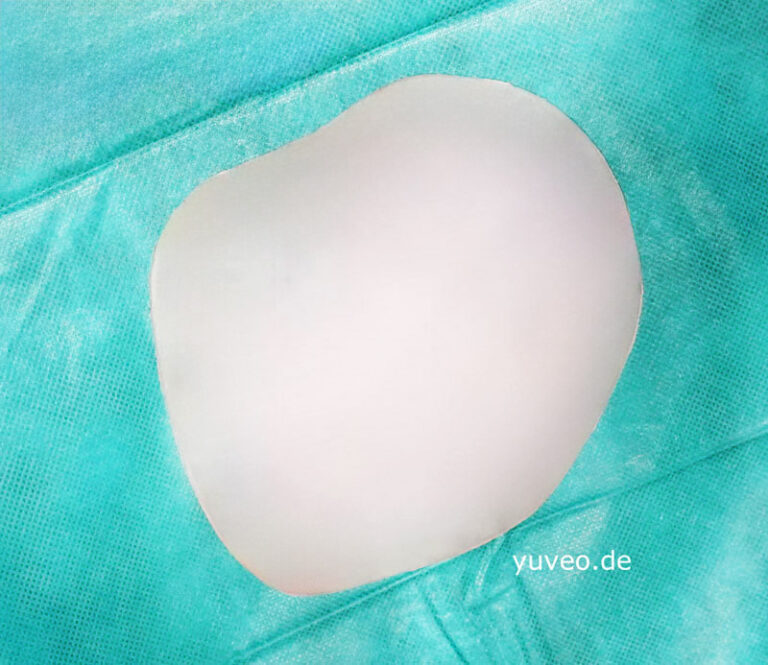 Customized funnel chest implant for surgery